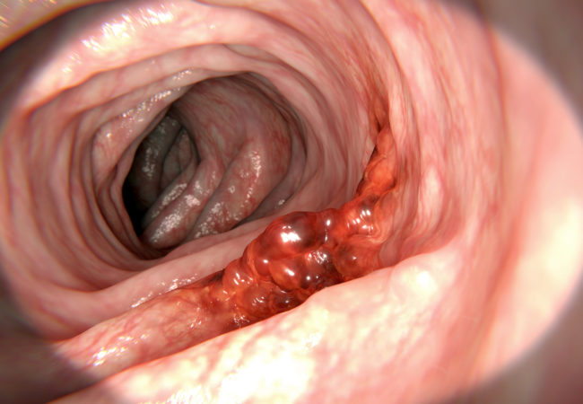 cancerous tumor in a colon