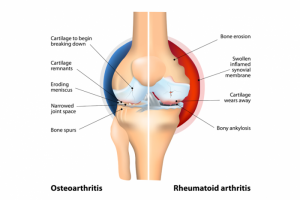 knee joint showing comparison of osteoarthritis to rheumatoid arthritis